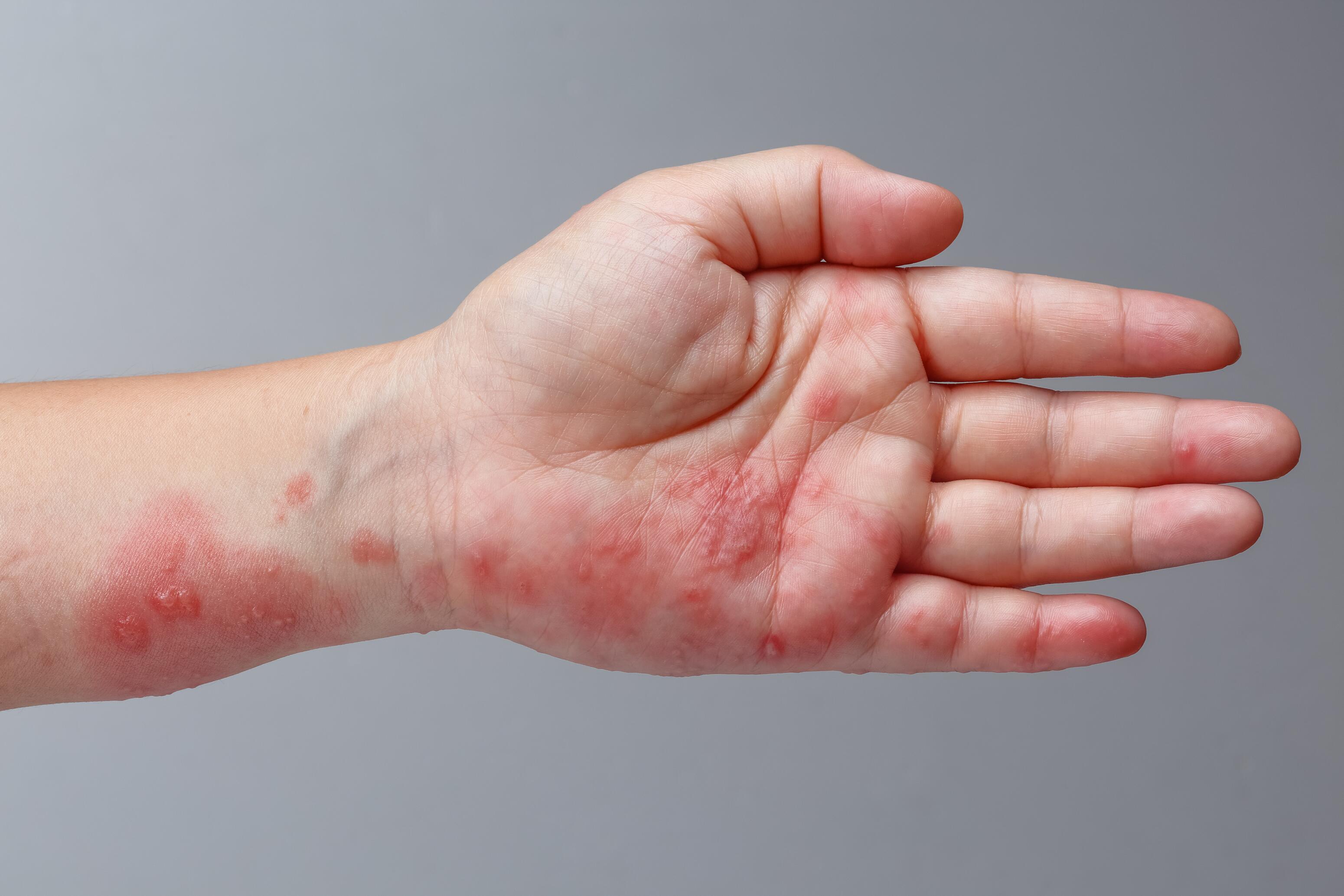 Mycoses gale et autres causes infectieuses demangeaison sur tout le corps